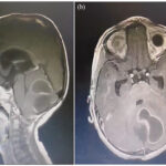 enterobacter meningitis