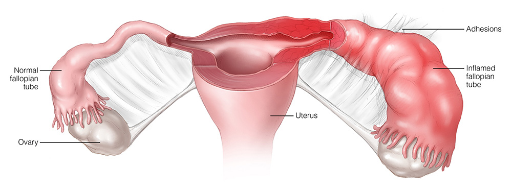 enterobacter pelvic inflammatory disease