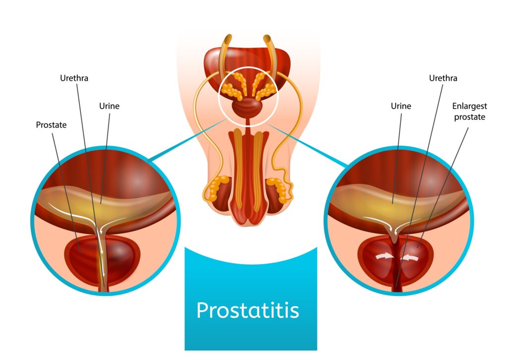 enterobacter prostatitis