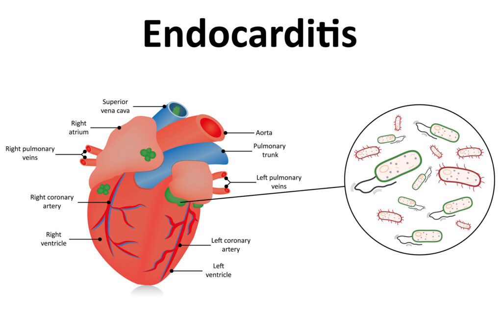 enterococcal endocarditis