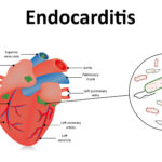 enterococcal endocarditis