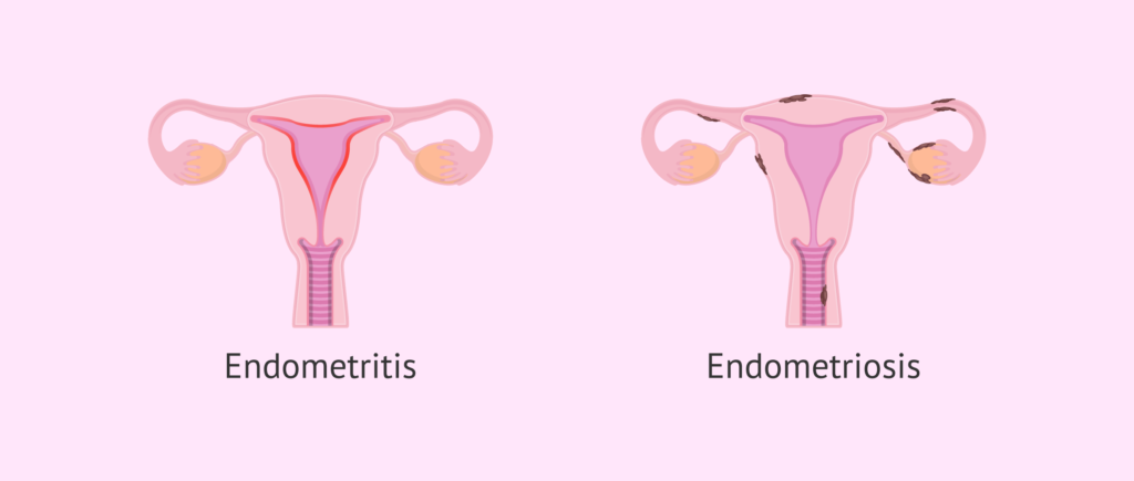 enterococcus endometritis