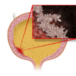 enterococcus faecalis urinary tract infection