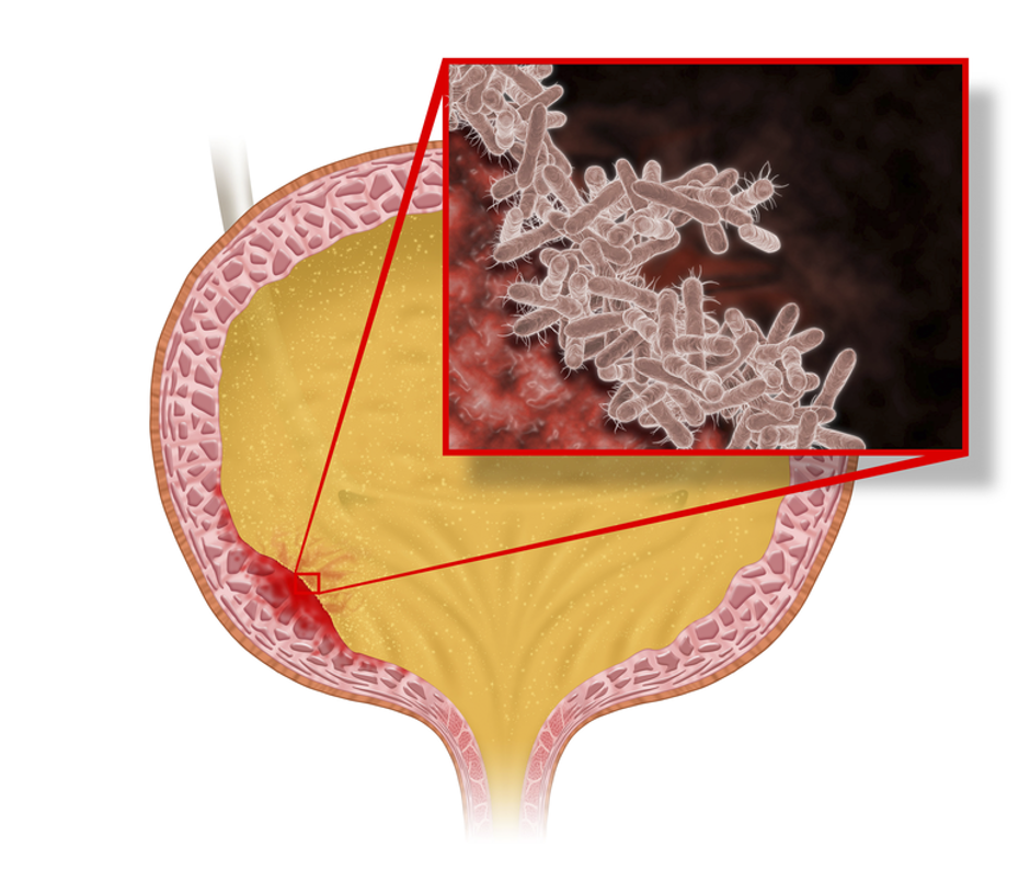 enterococcus faecalis urinary tract infection