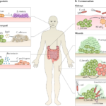 enterococcus joint infection