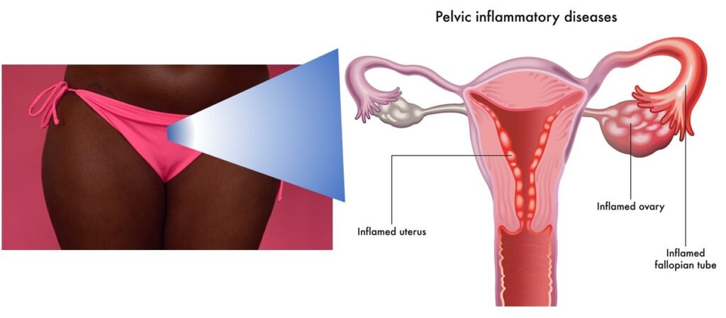 enterococcus pelvic inflammatory disease