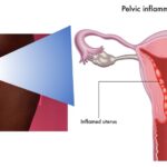 enterococcus pelvic inflammatory disease