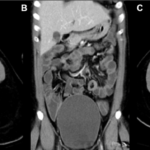 enterocolitis