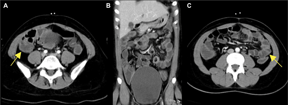 enterocolitis