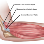 epicondylitis