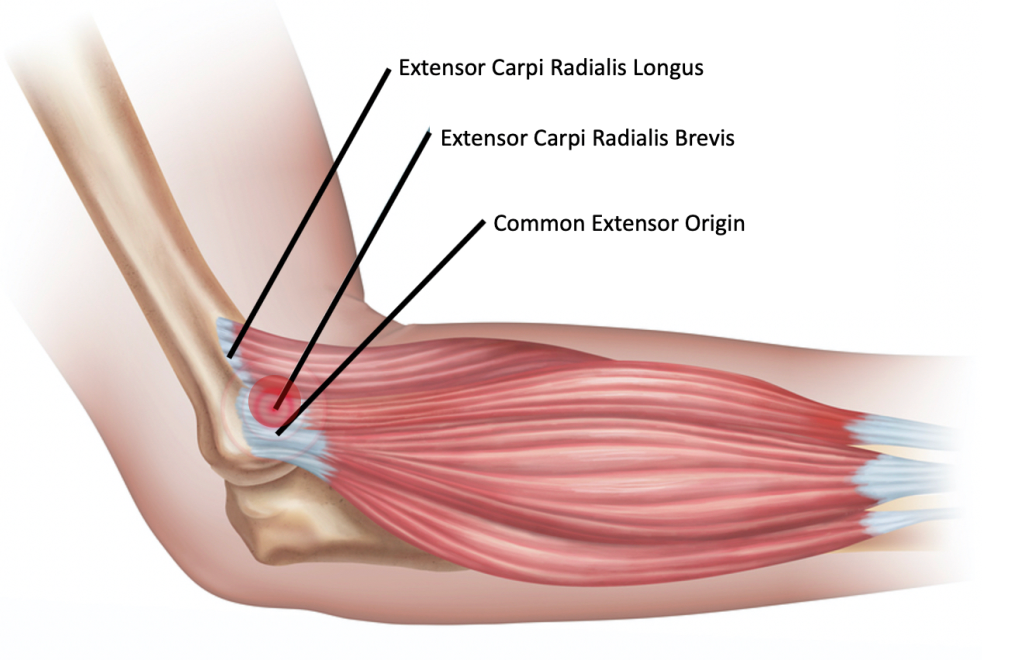 epicondylitis