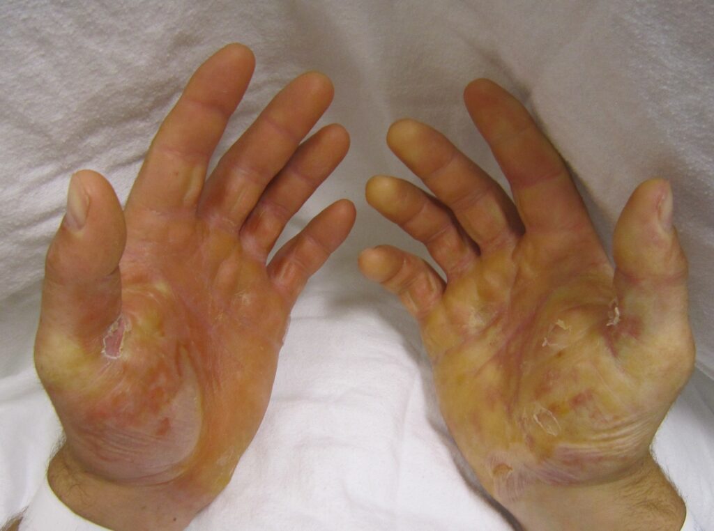 epidermolysis bullosa