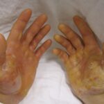 epidermolysis bullosa