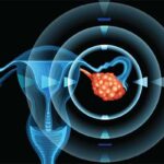 epithelial ovarian cancer