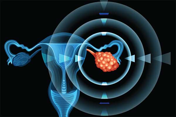 epithelial ovarian cancer