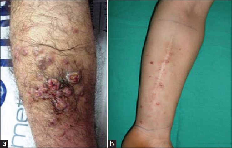 epithelioid sarcoma