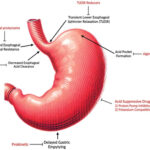 erosive esophagitis