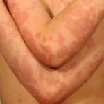 erythema multiforme