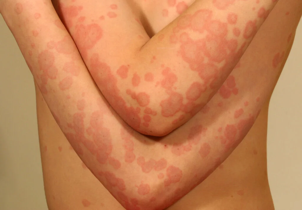 erythema multiforme