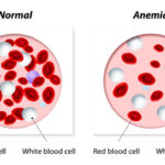 erythroblastic anemia