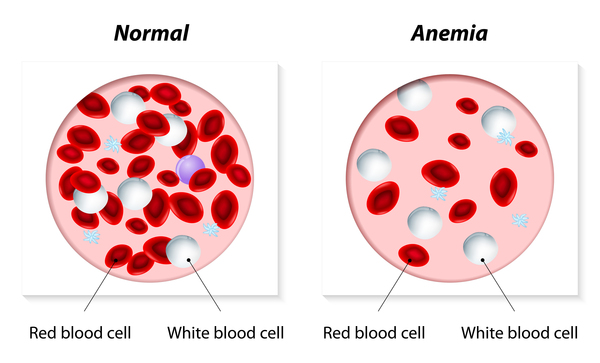 erythroblastic anemia