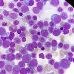 erythroblastic anemia