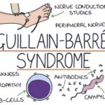 Guillain-Barré Syndrome