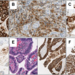 HER2-Negative and CLDN18.2-Positive Gastric