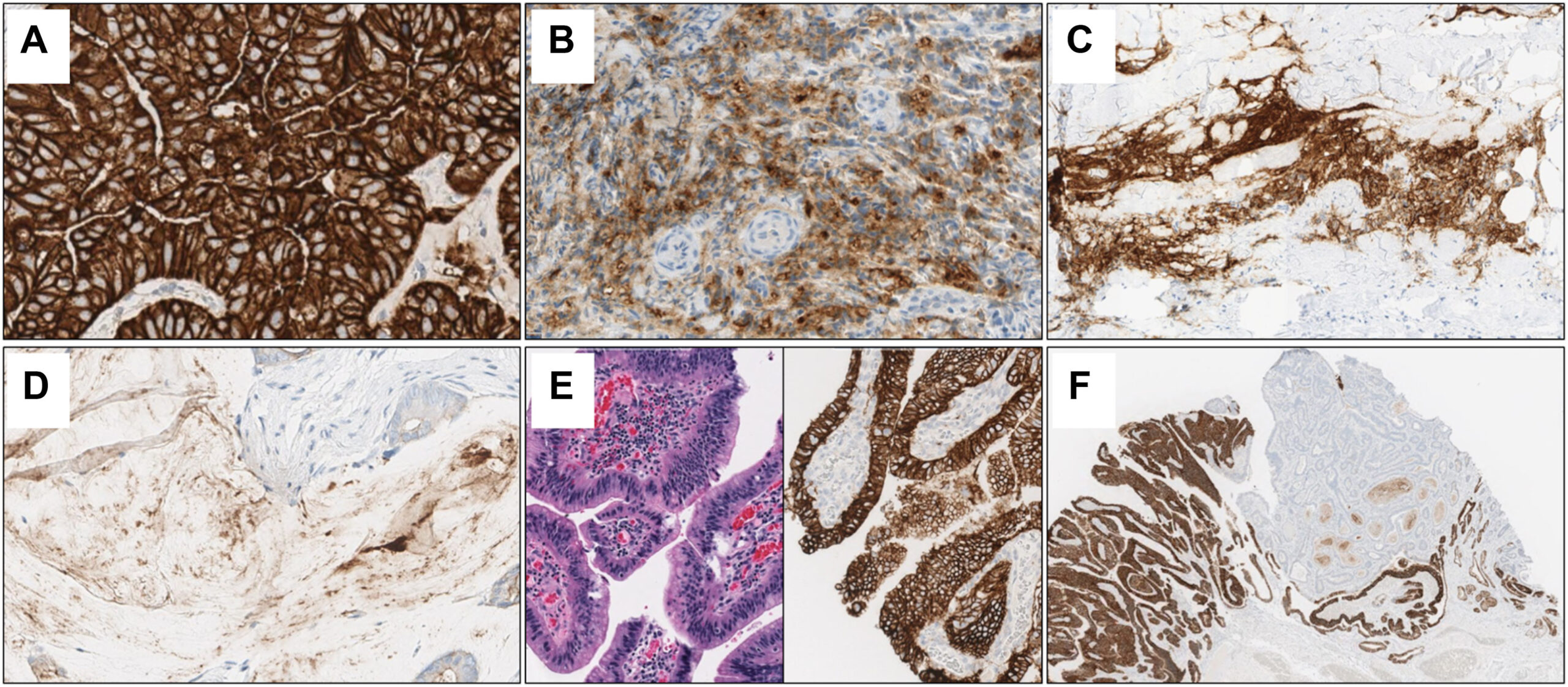 HER2-Negative and CLDN18.2-Positive Gastric