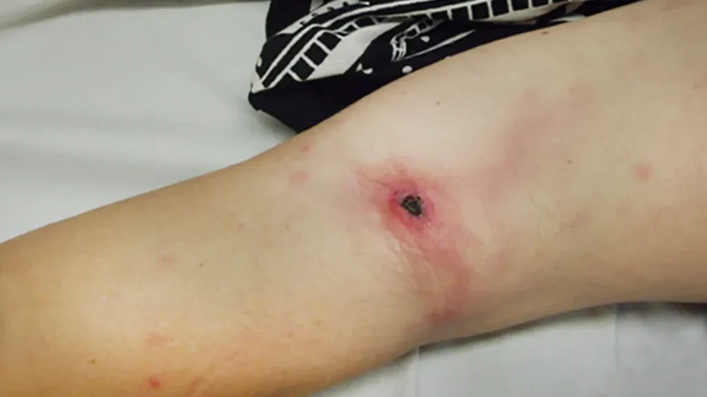 eschar removal from thermal burn wound