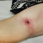 eschar removal from thermal burn wound