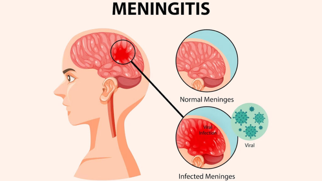 escherichia coli meningitis