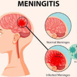 escherichia coli meningitis