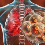 escherichia coli pneumonia