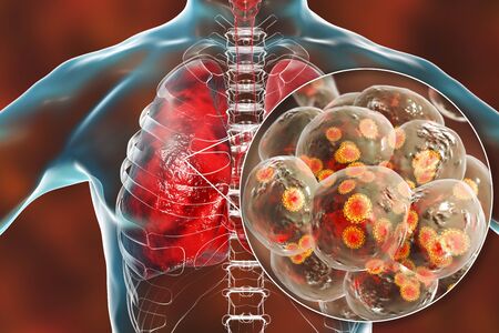 escherichia coli pneumonia