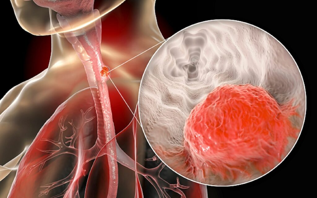 esophageal candidiasis