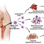 essential thrombocytosis