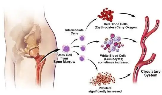 essential thrombocytosis