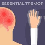 essential tremor