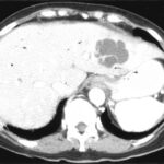 eubacterium liver abscess