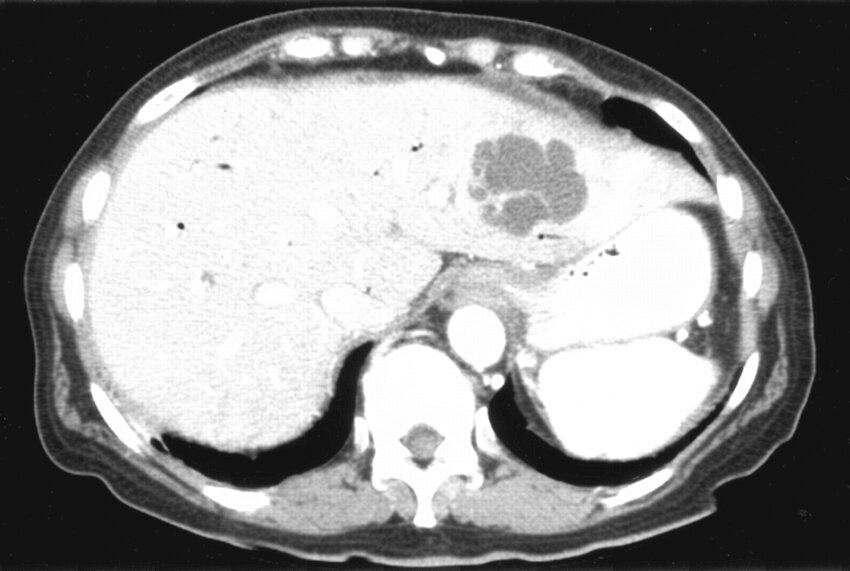 eubacterium liver abscess