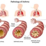 exercise-induced bronchospasm prevention