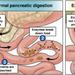 exocrine pancreatic insufficiency