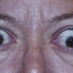 exposure keratoconjunctivitis