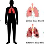 extensive-stage small cell lung cancer