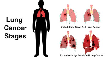 extensive-stage small cell lung cancer