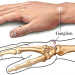 ganglion cyst