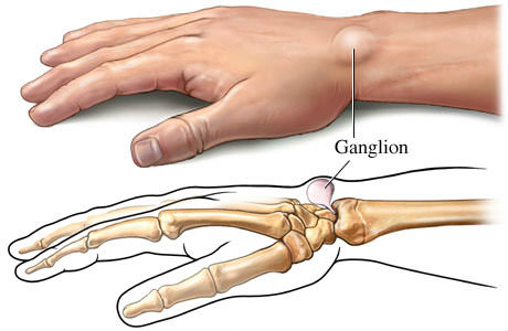 ganglion cyst