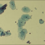 gardnerella vaginalis bacterial vaginosis