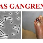 gas gangrene caused by clostridium perfringens